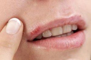 cold-sore-image-of-herpes